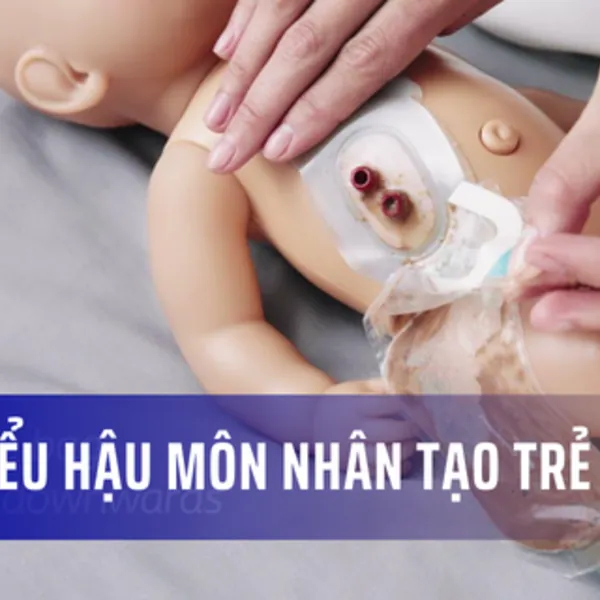 Tìm hiểu thêm về hậu môn nhân tạo cho trẻ em