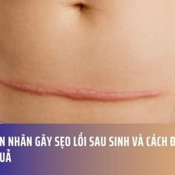 NGUYÊN NHÂN GÂY SẸO LỒI SAU SINH VÀ CÁCH ĐIỀU TRỊ HIỆU QUẢ