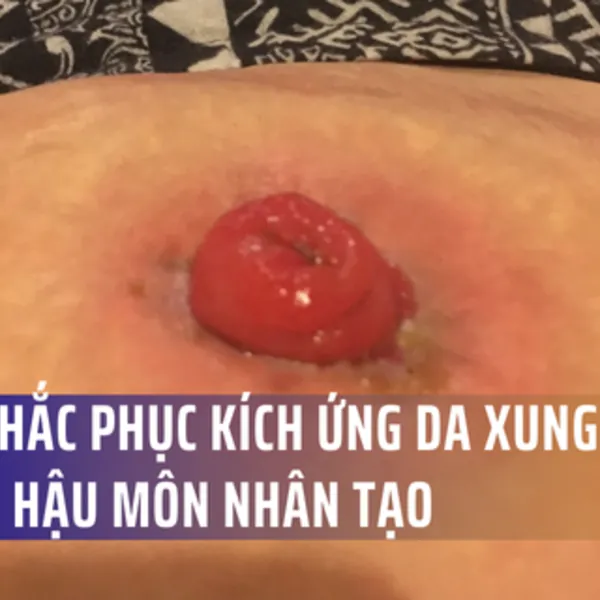 Khắc phục tình trạng kích ứng da xung quanh hậu môn nhân tạo