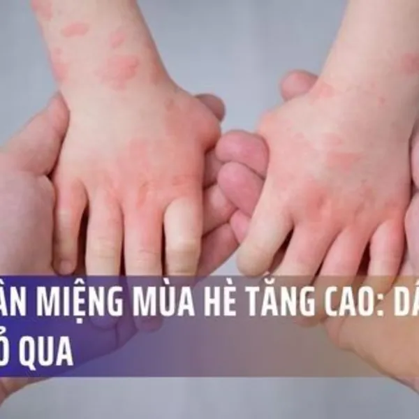 Tay Chân Miệng Mùa Hè Tăng Cao: Dấu Hiệu Dễ Bị Bỏ Qua