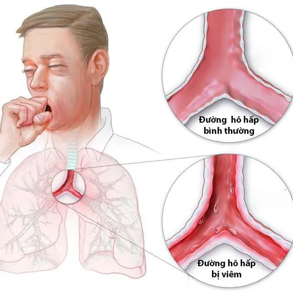 Làm thế nào để giữ hệ hô hấp khỏe mạnh mỗi ngày?
