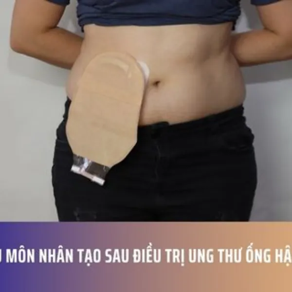Hậu Môn Nhân Tạo Sau Điều Trị Ung Thư Ống Hậu Môn