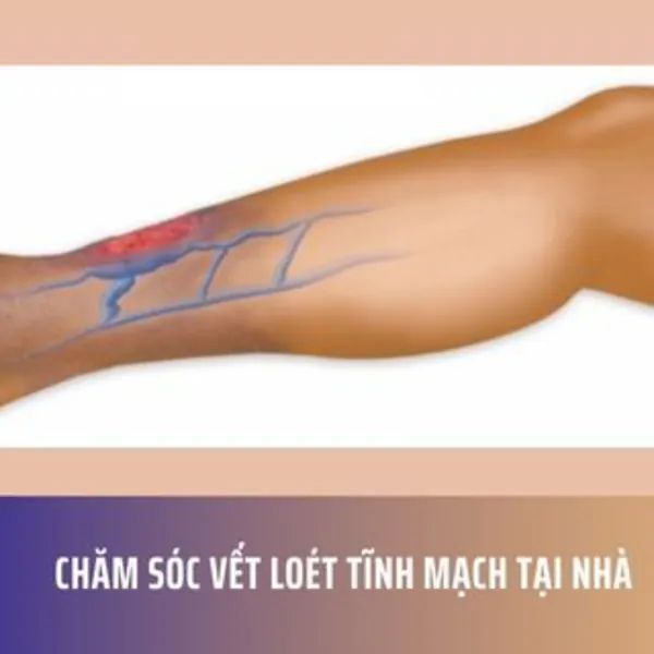 Chăm sóc vết loét tĩnh mạch tại nhà