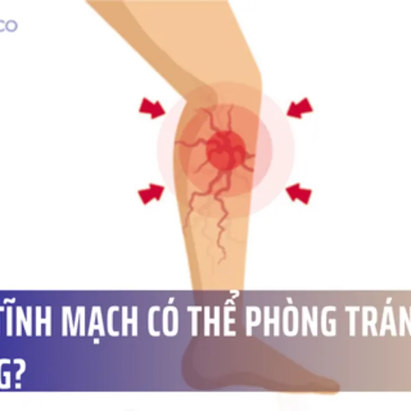 Loét tĩnh mạch có thể phòng tránh được hay không?