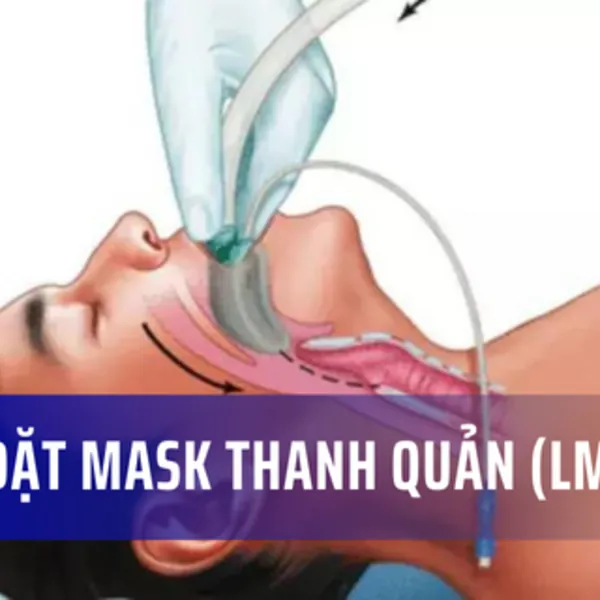 Cách đặt mask thanh quản (LMA): Hướng dẫn chi tiết