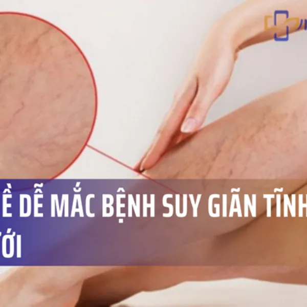 11 nghề dễ mắc bệnh suy giãn tĩnh mạch chi dưới