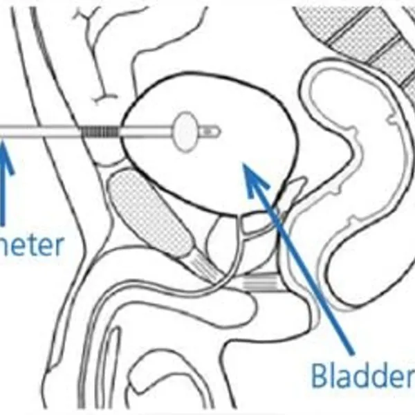 Hướng Dẫn Chăm Sóc Dẫn Lưu Bàng Quang Trên Xương Mu