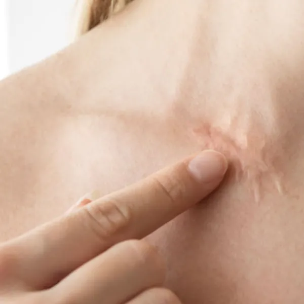 GEL SILICON : Sản phẩm tối ưu để chữa lành làn da sau xâm lấn