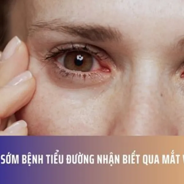 Dấu Hiệu Sớm Bệnh Tiểu Đường Nhận Biết Qua Mắt Và Miệng