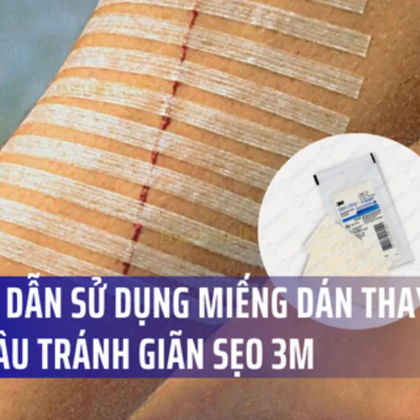 Miếng dán vết thương thay chỉ khâu 3M Steri Strip: Hướng dẫn sử dụng
