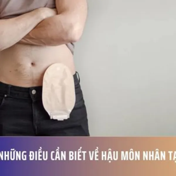 Những điều cần biết về hậu môn nhân tạo