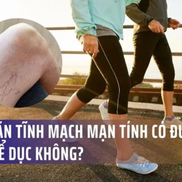 Suy giãn tĩnh mạch mạn tính có được tập thể dục không?