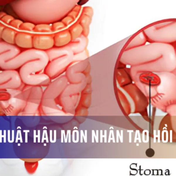 Phẫu thuật hậu môn nhân tạo hồi tràng