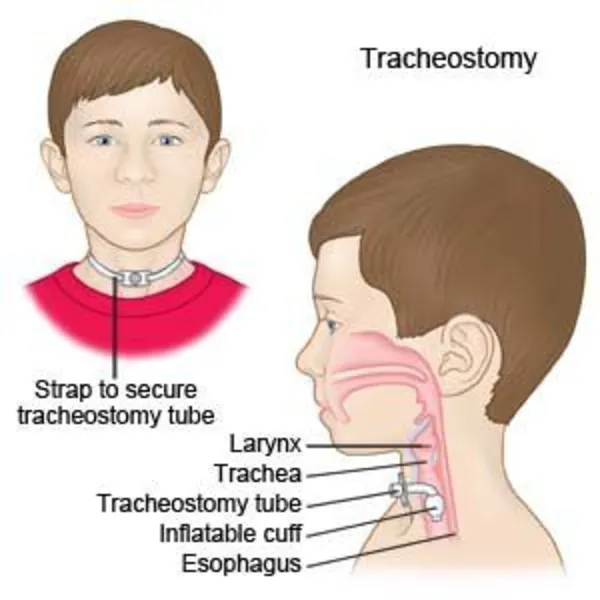 Thay ống mở khí quản phần 1