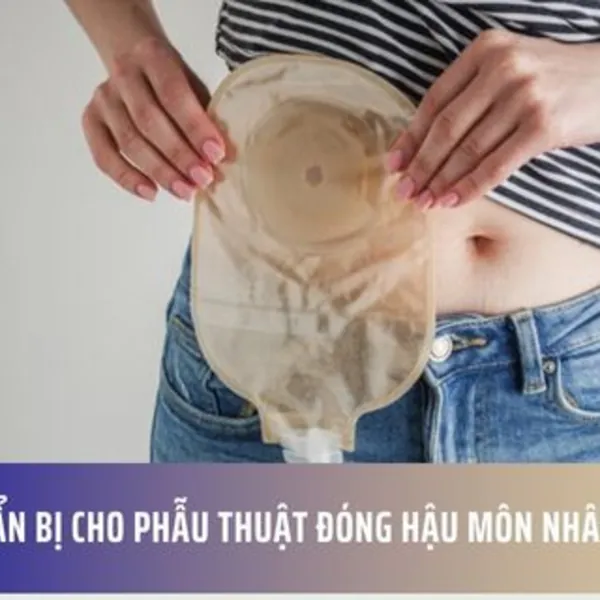 Chuẩn bị cho phẫu thuật đóng hậu môn nhân tạo
