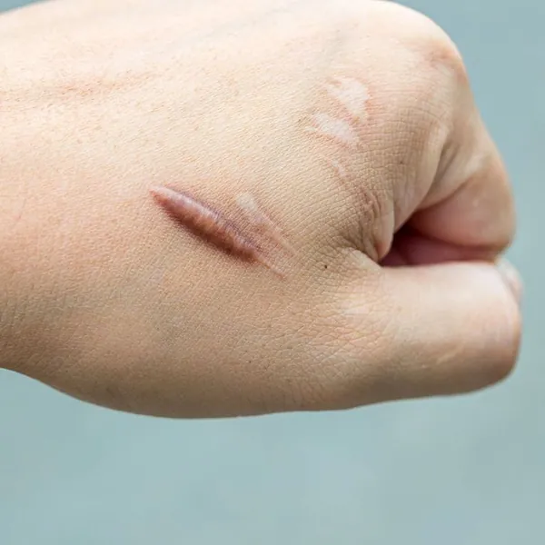 Có những loại sẹo nào và cách phân biệt sẹo.