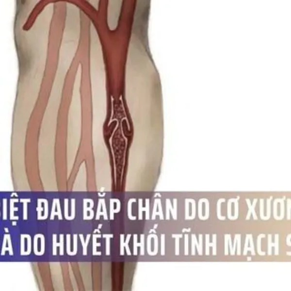 Phân biệt đau bắp chân do cơ xương khớp và do huyết khối tĩnh mạch sâu (DVT)