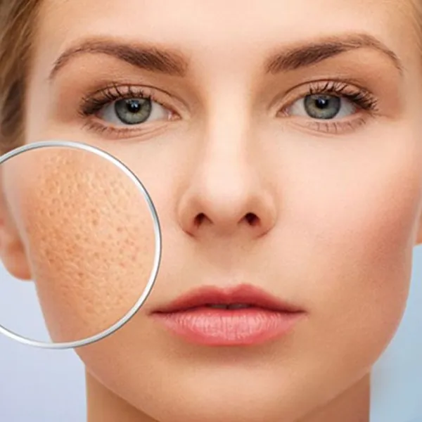 4 Phương Pháp Giảm Sẹo Lõm Sẹo Rỗ Hiệu Quả
