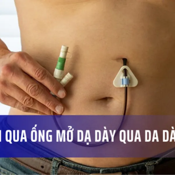 Nuôi ăn qua ống mở dạ dày qua da dài ngày tại nhà