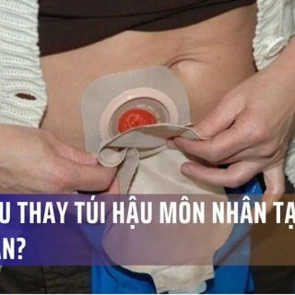 Bao lâu thay túi hậu môn nhân tạo một lần?