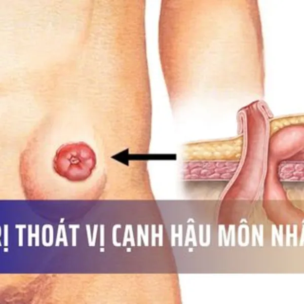 Cách điều trị thoát vị cạnh hậu môn nhân tạo