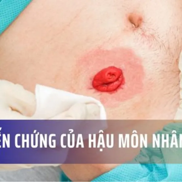 Một số biến chứng phổ biến của hậu môn nhân tạo