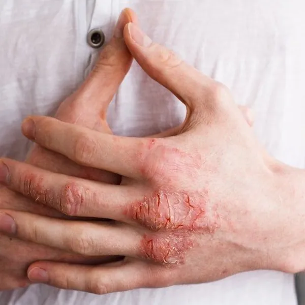 Loét da là gì? Nguyên nhân và triệu chứng loét da