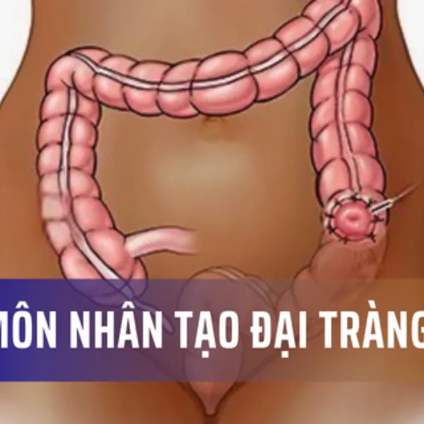 Hậu môn nhân tạo đại tràng là gì?