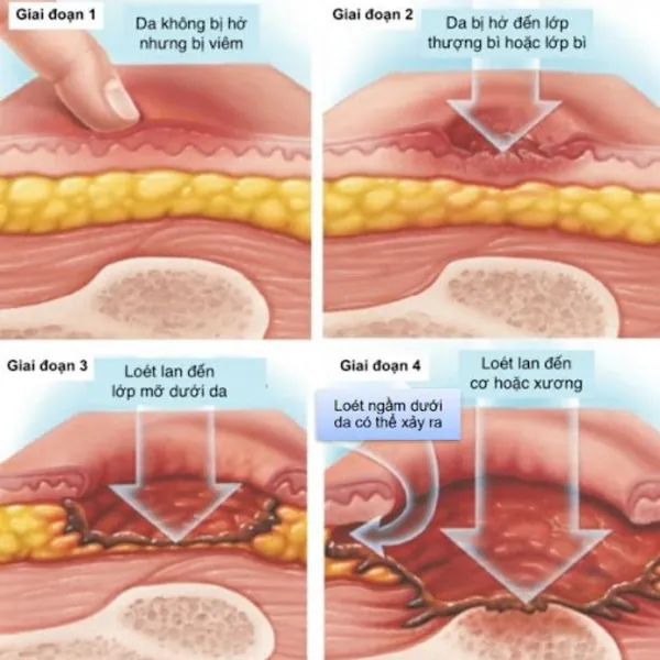 Nguyên nhân và triệu chứng của loét da do áp lực tì đè
