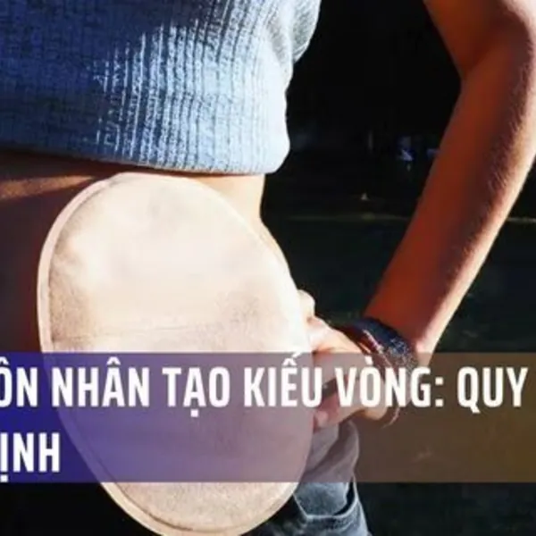 Hậu Môn Nhân Tạo Kiểu Vòng: Quy Trình & Chỉ Định
