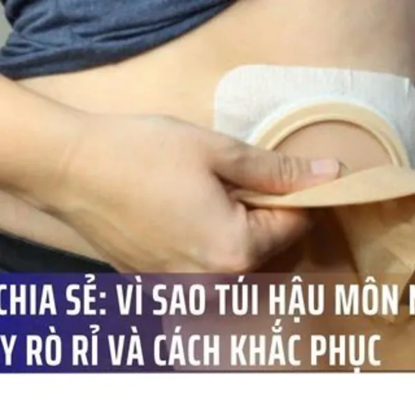 Bác sĩ chia sẻ: Vì sao túi hậu môn nhân tạo hay rò rỉ và cách khắc phục