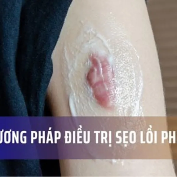 Các phương pháp điều trị sẹo lồi phổ biến