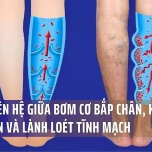 Mối Liên Hệ Giữa Bơm Cơ Bắp Chân, Khớp Cổ Chân và Lành Loét Tĩnh Mạch