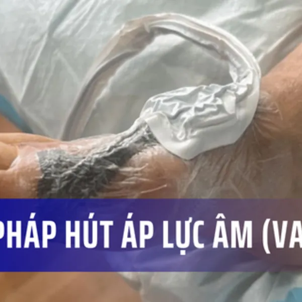 Liệu pháp hút áp lực âm điều trị vết thương (VAC)