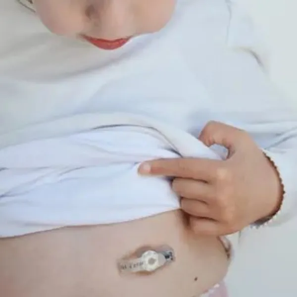 Các chuyên gia khuyến nghị gì để chuẩn bị trước khi nuôi ăn qua ống Sonde đường ruột