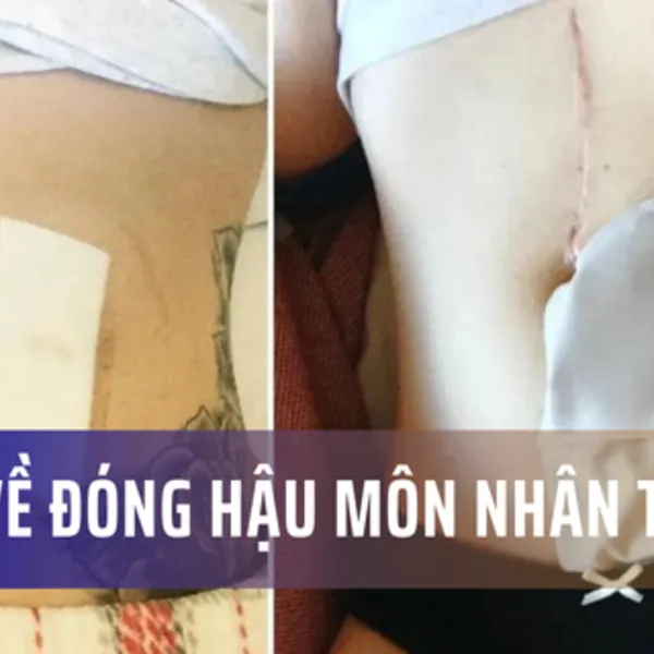 Một số câu hỏi thường gặp về quy trình đóng hậu môn nhân tạo