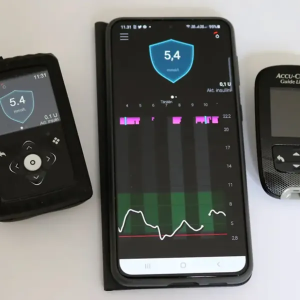 Hệ thống vòng kín lai MiniMed mới giúp tăng cường kiểm soát glucose ở bệnh nhân tiểu đường tuýp 1