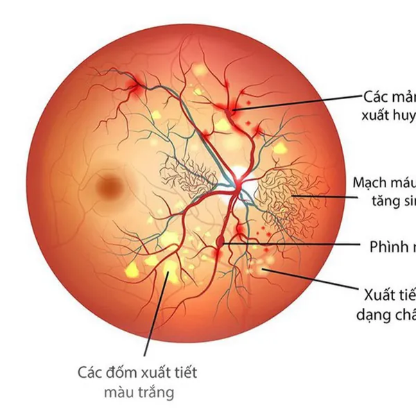 Bệnh võng mạc đái tháo đường, nguyên nhân triệu chứng và cách chữa trị