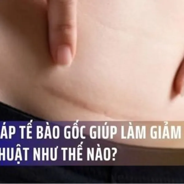 Liệu pháp Tế bào Gốc Giúp Làm Giảm Sẹo Phẫu Thuật Như Thế Nào?