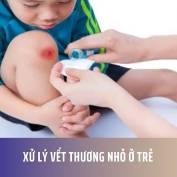 Xử lý vết thương nhỏ ở trẻ