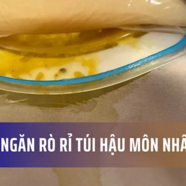 8 cách ngăn chặn rò rỉ túi hậu môn nhân tạo