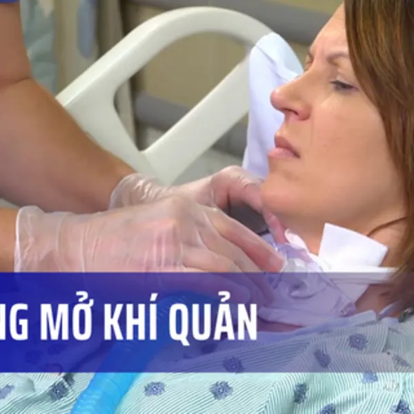 Cai ống mở khí quản