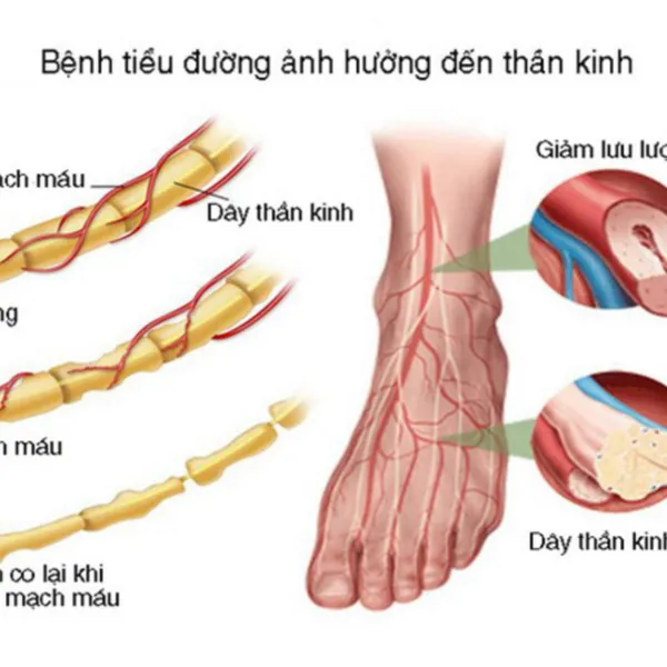 Tại sao đái tháo đường gây loét bàn chân?