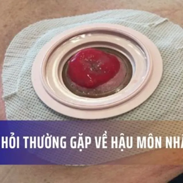 Các câu hỏi thường gặp với Hậu môn nhân tạo