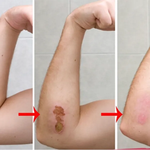 Gel bôi healit có dùng được cho vết thương hở ở vùng kín không?