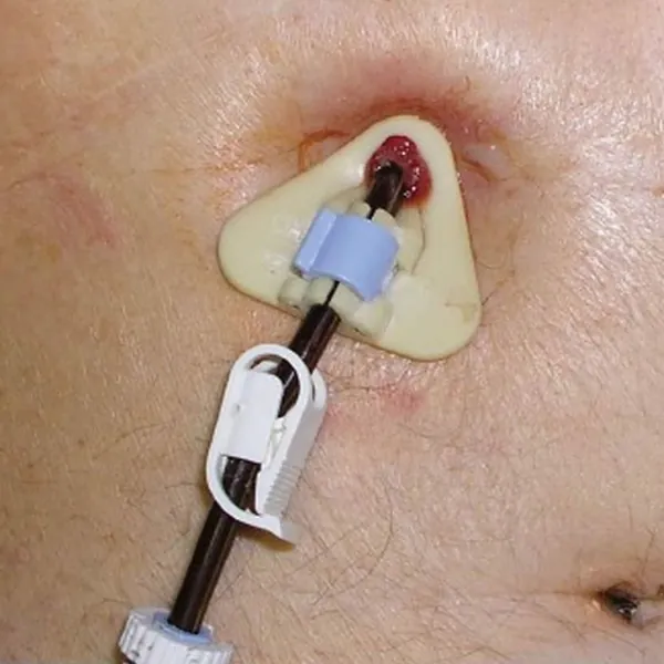 Hướng dẫn chăm sóc ống mở dạ dày ra da qua nội soi PEG