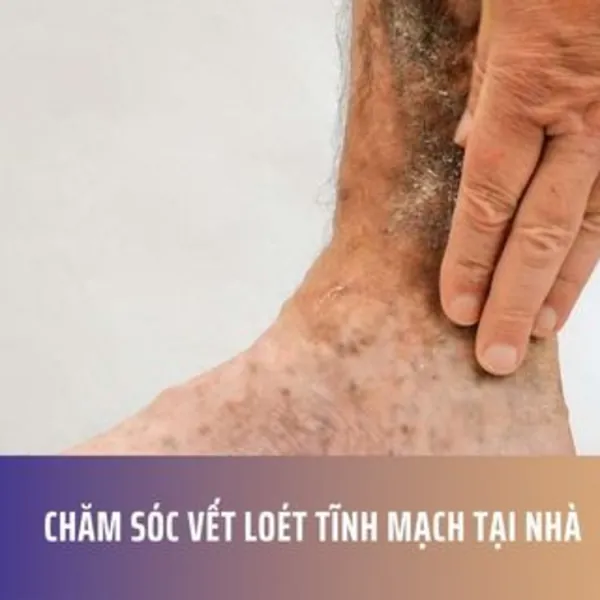 Chăm sóc vết loét tĩnh mạch tại nhà