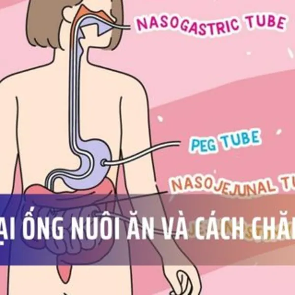 Các loại ống nuôi ăn và mẹo chăm sóc ống nuôi ăn