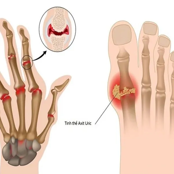 Rùng mình với tứ chi người đàn ông bị biến dạng khớp do bệnh gout