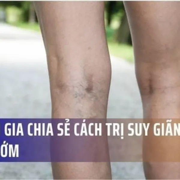 Chuyên Gia Chia Sẻ Cách Trị Suy Giãn Tĩnh Mạch Sớm